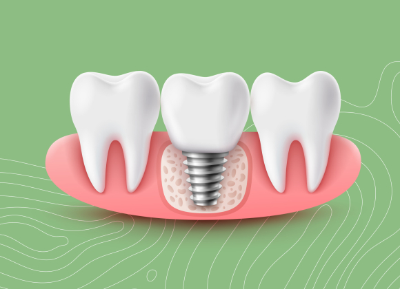 Dental implants in Asheville, NC