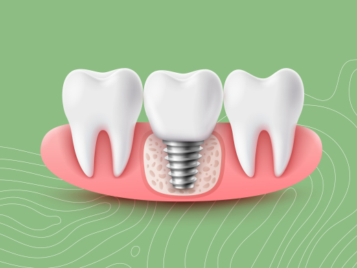 Dental implants in Asheville, NC