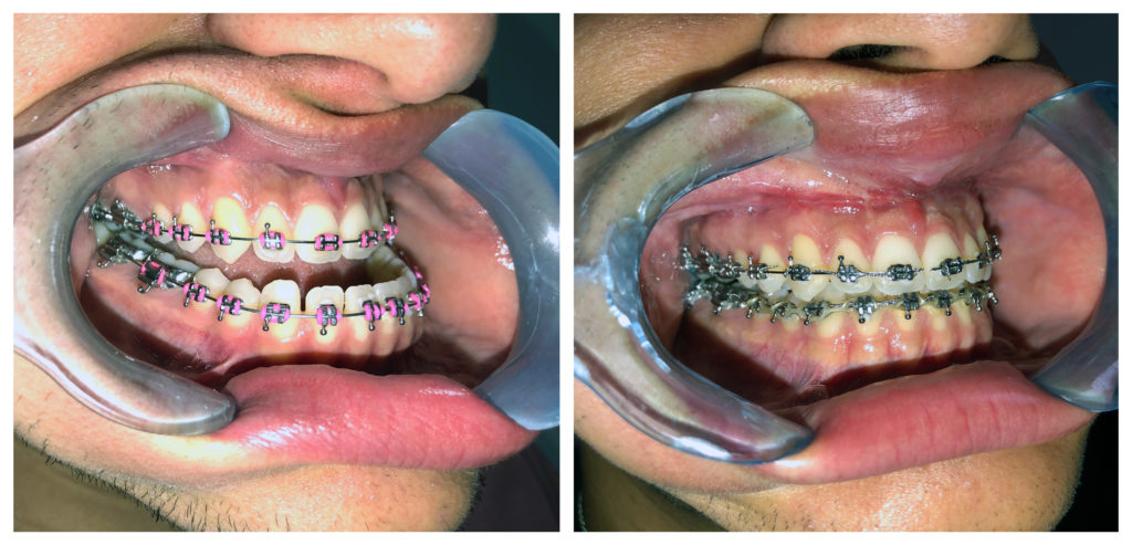 Corrective Jaw Surgery before and after